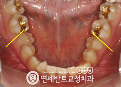 아래 치열 사진