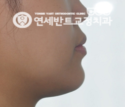 옆모습 턱선