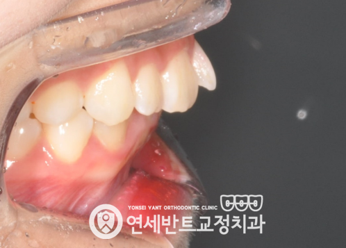 측면 교합 사진