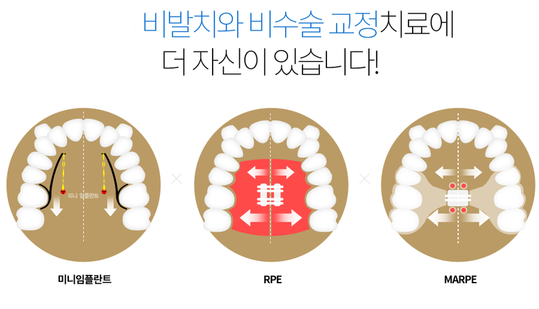 확장장치 종류