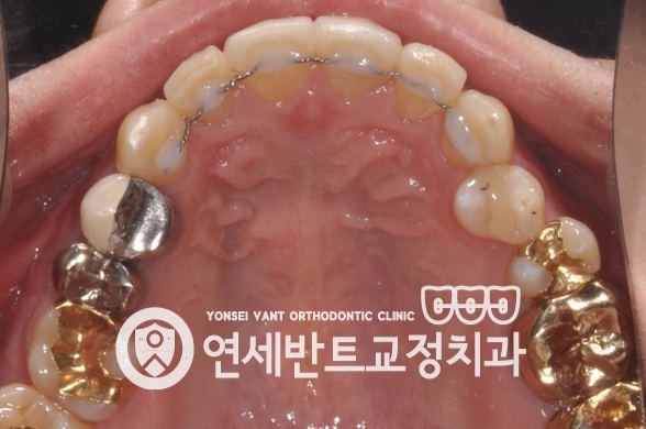 위턱 확장장치