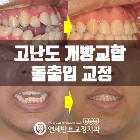 개방·반대·주걱턱 교합이 겹칠 때 — 구월동 교정치과 접근