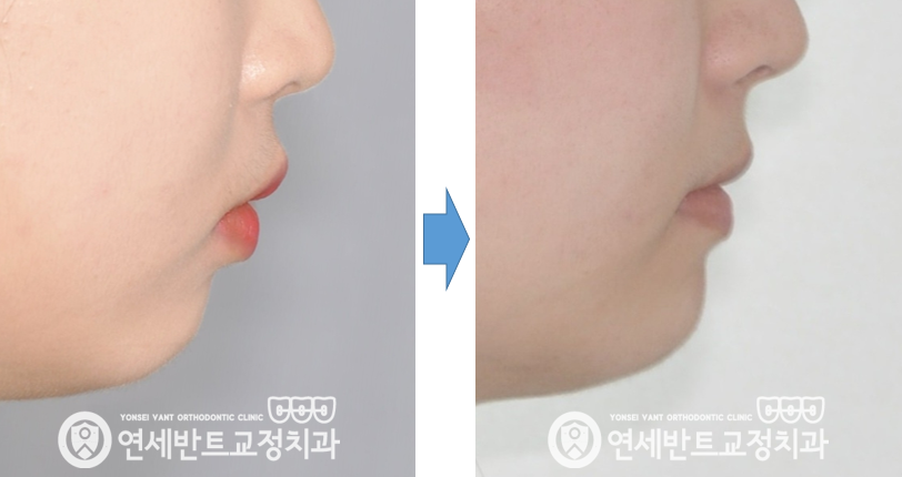 옆모습 전후 비교