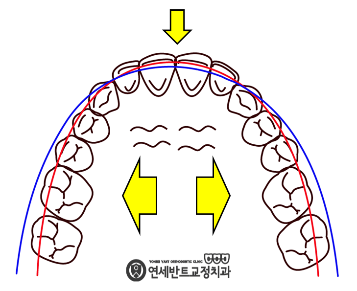 악궁 확장 도해