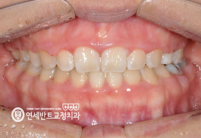 앞니 정면 사진