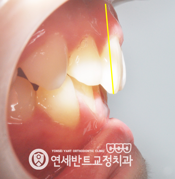 앞니 측면 확대