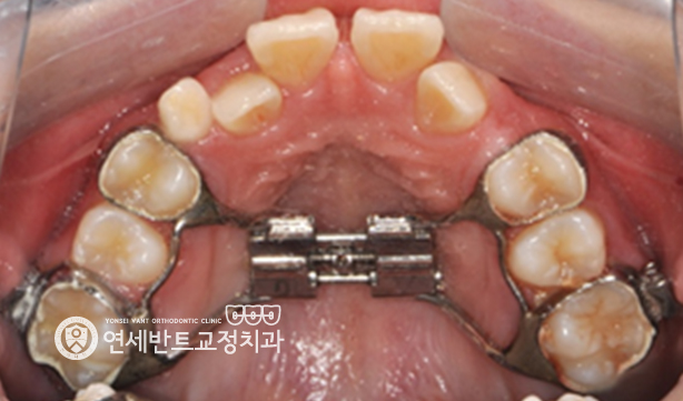위턱 확장장치