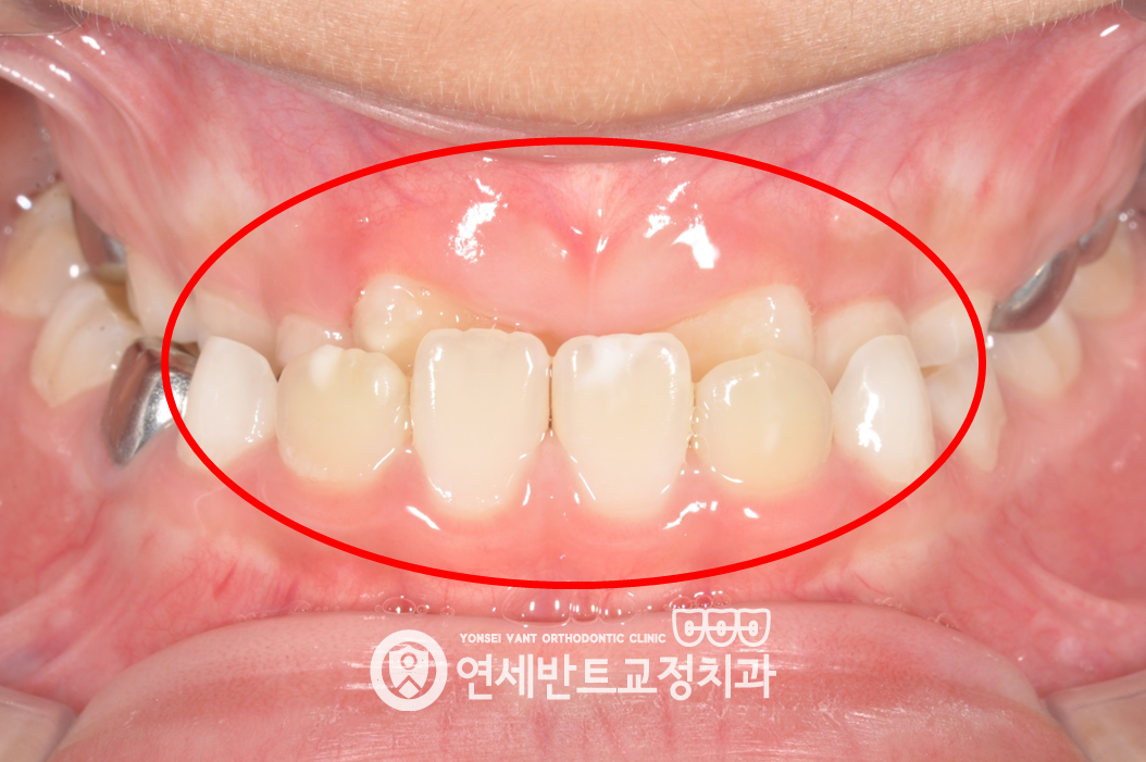 앞니 정면 사진