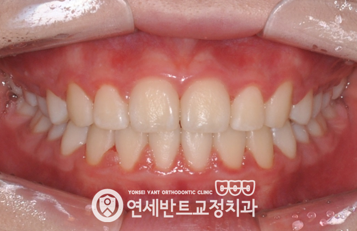 앞니 정면 사진