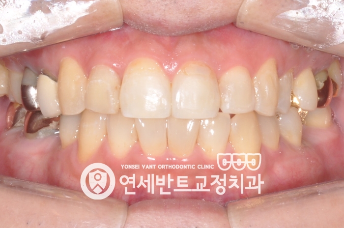앞니 정면 사진