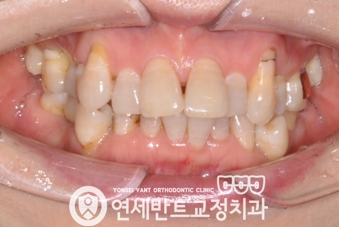 앞니 정면 사진