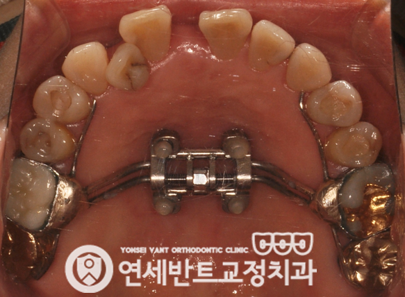 위턱 확장장치