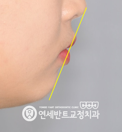 옆모습 기준선