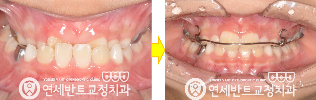 교정 전후 비교