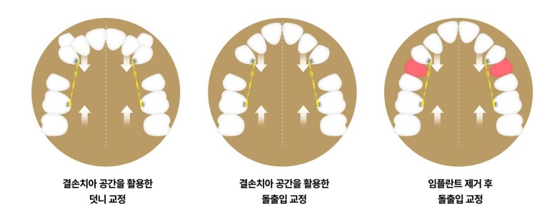 교정 방법 도해
