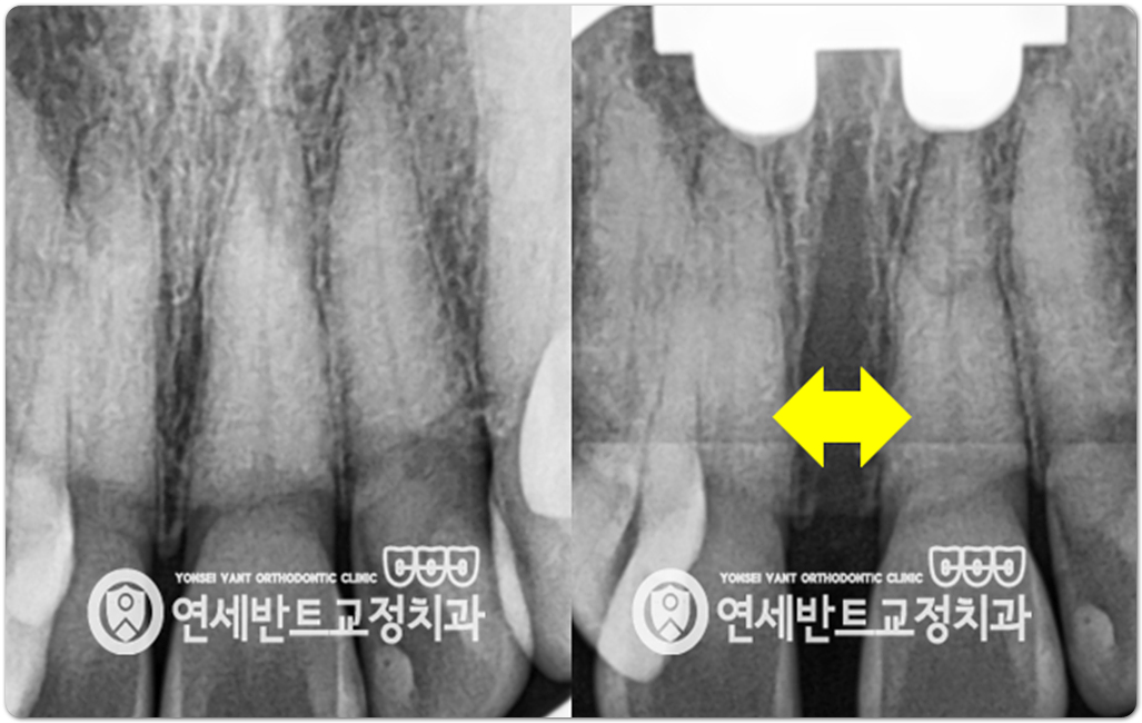 어금니 X레이