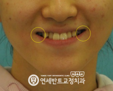 입 주변 사진