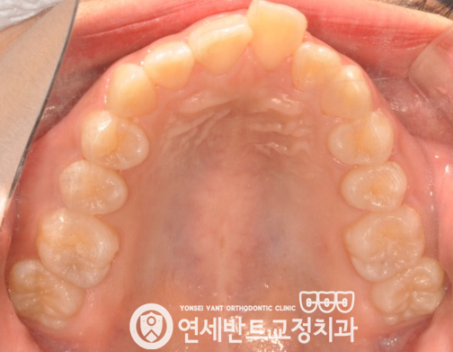 위 치열 사진