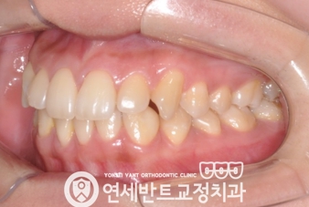 측면 교합 사진