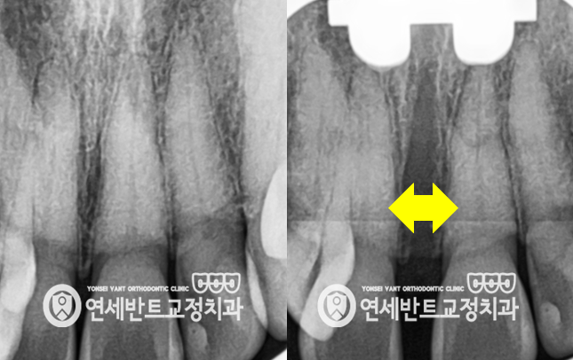 어금니 X레이
