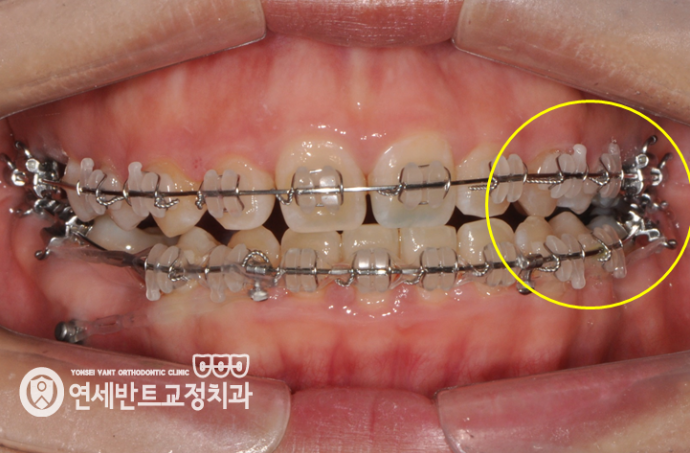 측면 장치 사진