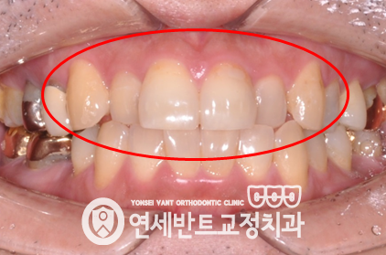 앞니 정면 사진