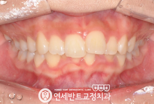 앞니 정면 사진