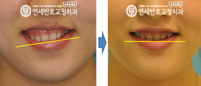 교정 전후 비교