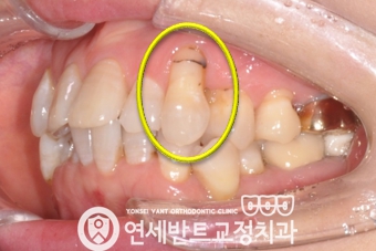 측면 교합 사진