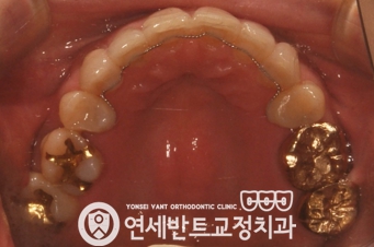 위 치열 사진