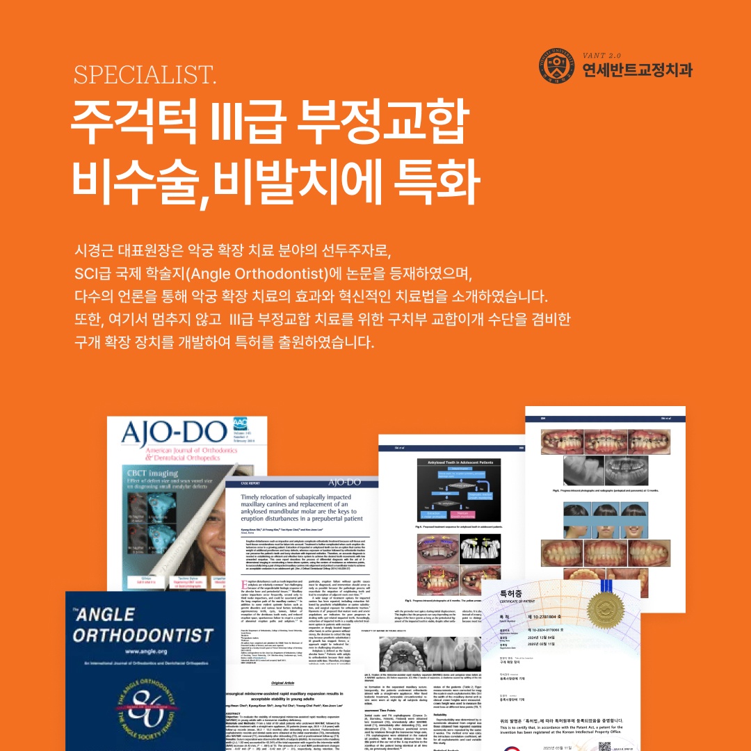 비발치 교정 안내