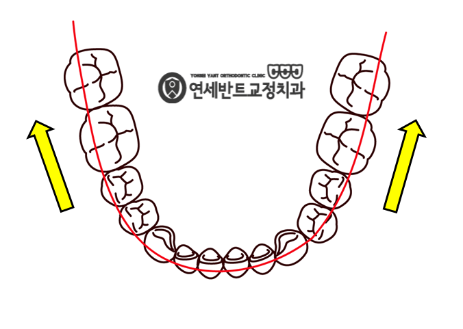 치열 확장 도해