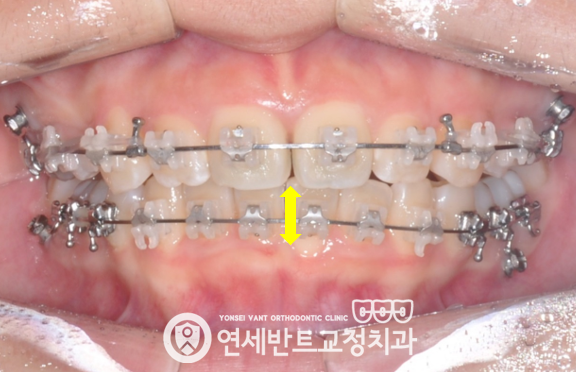 교정 장치 사진