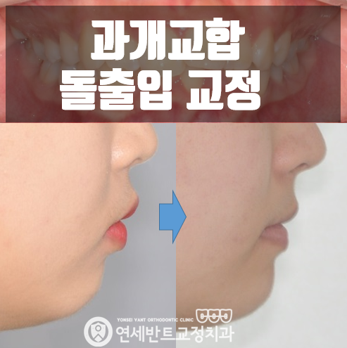 과개교합, 인천 교정치과에서 보는 편안한 미소 만들기