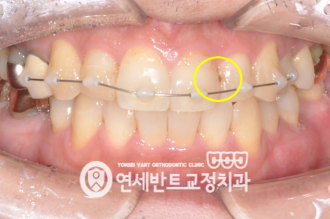 교정 장치 사진