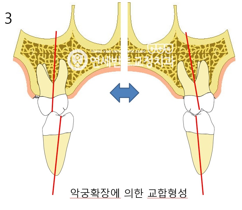 악궁 확장 도해