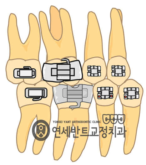 치아 배열 도해