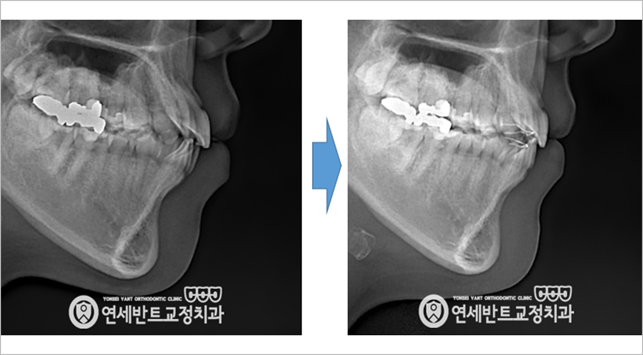측면 X레이 비교
