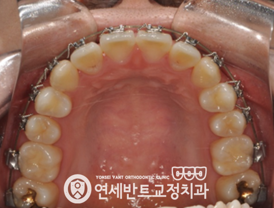 위 치열 사진