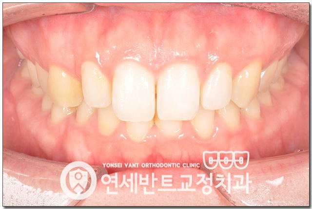 앞니 정면 사진