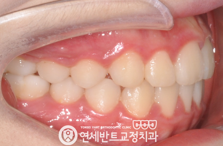 측면 교합 사진