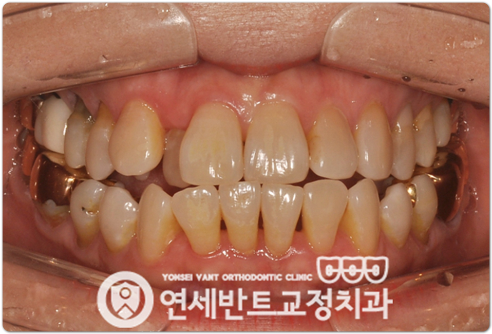 앞니 정면 사진