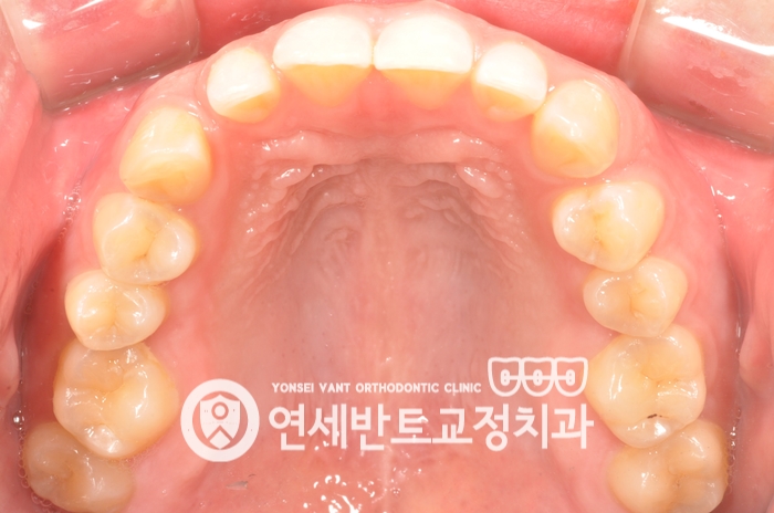 위 치열 사진