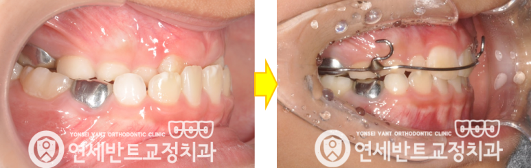 교정 전후 비교