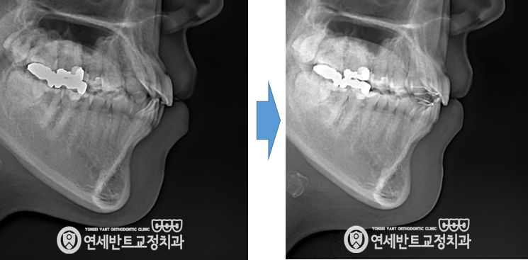 측면 X레이 비교