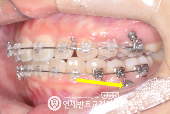 측면 장치 사진