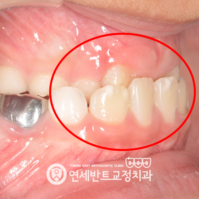 어금니 구강 사진