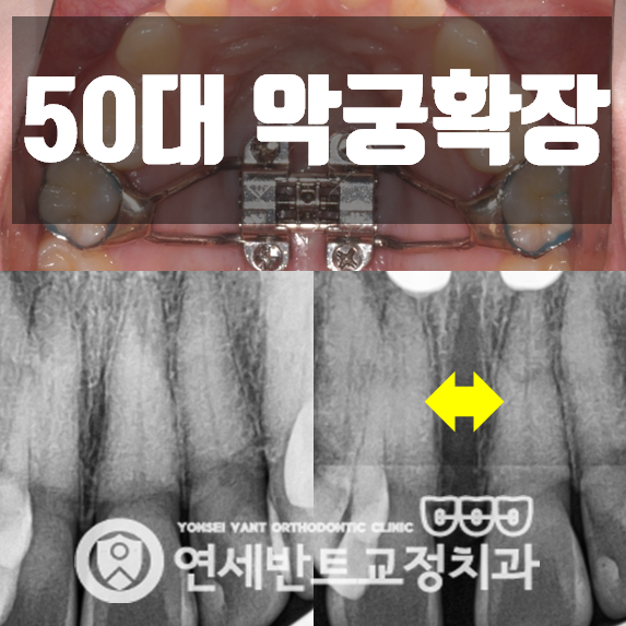 인천 남동구교정치과 50대 악궁확장