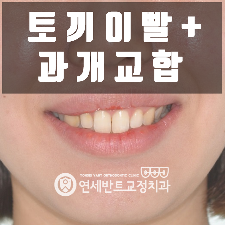 토끼앞니와 과개교합, 인천 치아교정으로 접근하기