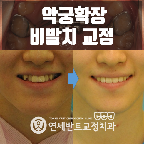 주안치아교정 방법 악궁확장을 통한 비발치 치료